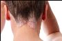  Ayurvedic And Alternative Treatment For Psoriasis