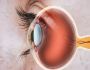 Laser eye surgery in delhi: What You Need to Know