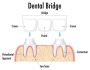 Dental Bridges for Front Teeth: Solution for Complete Smile