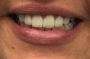 Top-Quality Porcelain Crowns for Lasting Dental Care in Chan