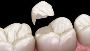 Say Goodbye to Tooth Pain – Cracked Tooth Repair in AZ