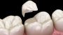 Durable Tooth Fillings in Chandler				
