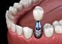 Same Day Dental Implants Near Me