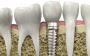 Dental Implants in Ahmedabad - Pramukh Dental Care