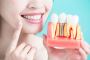 Affordable dental implants in Fort Worth
