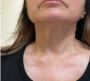 Why Double Chin Removal Is the Fast Track to a Slim Face