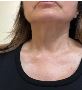 Double Chin Removal Without Surgery: Say Goodbye to Unwanted