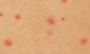 Chickenpox vaccination in Watford