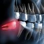Safe & Painless Wisdom Teeth Removal Surgery