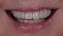 tooth cap cost - Prosmiles