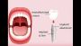 Dental Crowns: Types & Zirconia Advantages