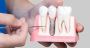 Transform Your Smile with Dental Implants at Purple Dental i