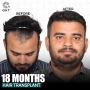 QHT Hair Transplant In Noida
