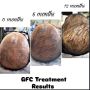 Hair Transplant in Ghatkopar by Dr. Avani Maniar
