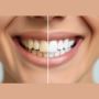 Dental Crowns in Park Street