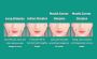Dimple Creation Treatment Delhi
