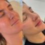 Lip Filler Treatment in Norwich & Fitzrovia | Regen Clinic