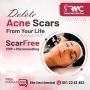 Acne scar Removal - Facial scars - Acne Marks - Acne scar: B