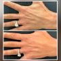 Woman’s Hands Before and After Laser Treatment