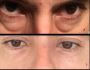 AGNES RF Microneedling: Your Path to Smooth, Youthful Skin