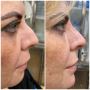 Nose Augmentation in Tucson, AZ – Transform Your Profile