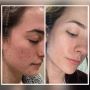 Effective Treatments for Acne Scars and Skin Conditions