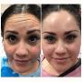 Revitalize Your Look with Botox Treatments