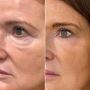 Effective Solutions for Under-Eye Bags and Festoons