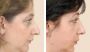 Enhance Your Profile with Expert Nose Augmentation