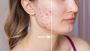 Effective Solutions for Acne Scars and Skin Conditions