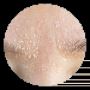 Dry Skin Treatment | Results Laser Online