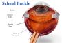 Affordable Scleral Buckle Eye Surgery in Indore by Retina Ex
