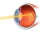 Advanced Retinal Laser Treatment Dubai for Eye Care