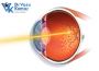 Affordable Retinal Laser Treatment Dubai for Eye Health