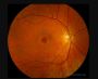 Plaquenil screening San Diego | Retina Center of San Diego