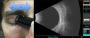 Eye ultrasound San Diego | Retina Center of San Diego