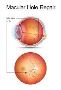 Macular Hole Surgery Specialist - Mahi Muqit