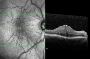 Expert Epiretinal Membrane Treatment
