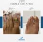 Fungal Nail Infections Treatment - Nail Fungus Treatment Lon