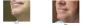 Cyst Removal London - Cyst Removal Clinic London
