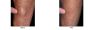 Lipoma Removal Cost London - Lipoma Removal Clinic