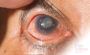 Is Turkey the Best Destination for Laser Eye Surgery?