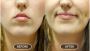 Best Dimple Creation Surgery Hospital in Jaipur