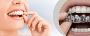 Protect Your Teeth with Dental Night Guards in Georgetown