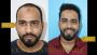 Best Hair Transplant Clinic and Surgeon in Bangalore | Dr Id