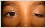 Congenital ptosis | Drooping of lids in Navi Mumbai - Utsav 