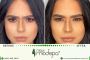 Top-Rated Botox in Orlando – Smooth, Natural Results!