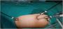 Best Laparoscopic Surgeon for Gall Stone Surgery in Kolkata