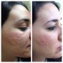Micro needling treatment in Islamabad