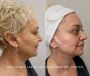 Revitalize Your Skin with DMK Muscle Banding at Safi Miran L